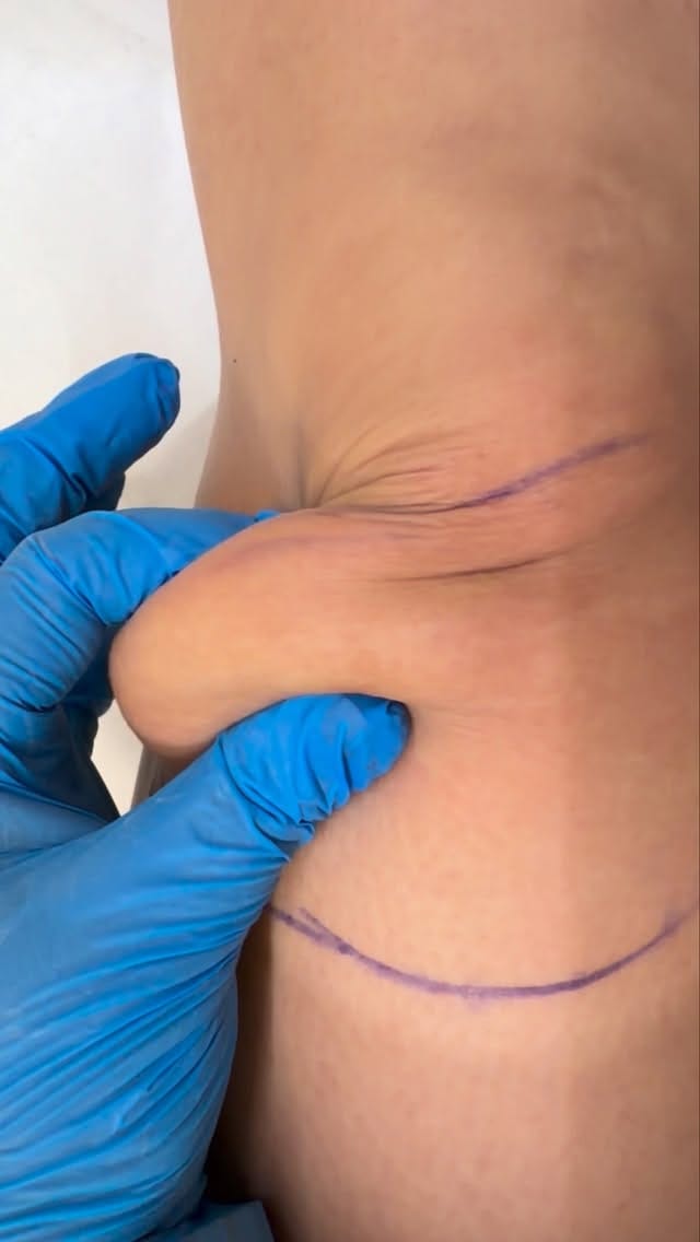 Post 5 by Dr Sima - BOTOX/LIP/FILLER/Endolift/Dubai on Instagram (video)