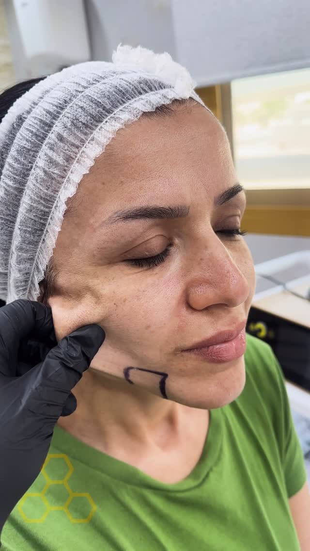 Post 10 by Dr Sima - BOTOX/LIP/FILLER/Endolift/Dubai on Instagram (video)