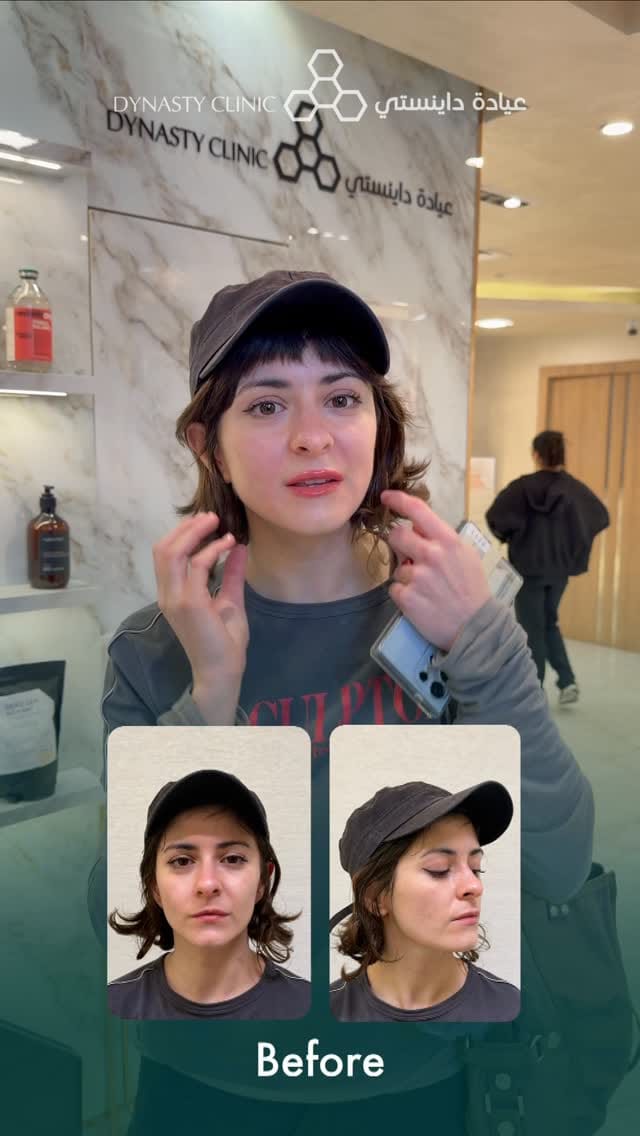 Post 3 by Dr Sima - BOTOX/LIP/FILLER/Endolift/Dubai on Instagram (video)
