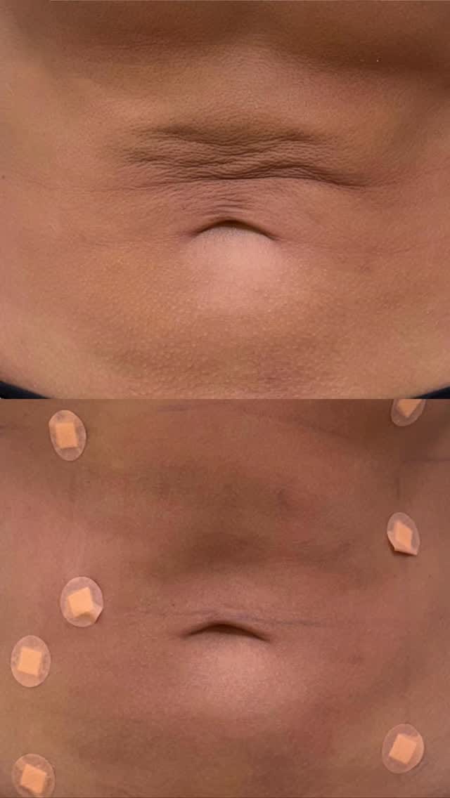 Post 2 by Dr Sima - BOTOX/LIP/FILLER/Endolift/Dubai on Instagram (video)