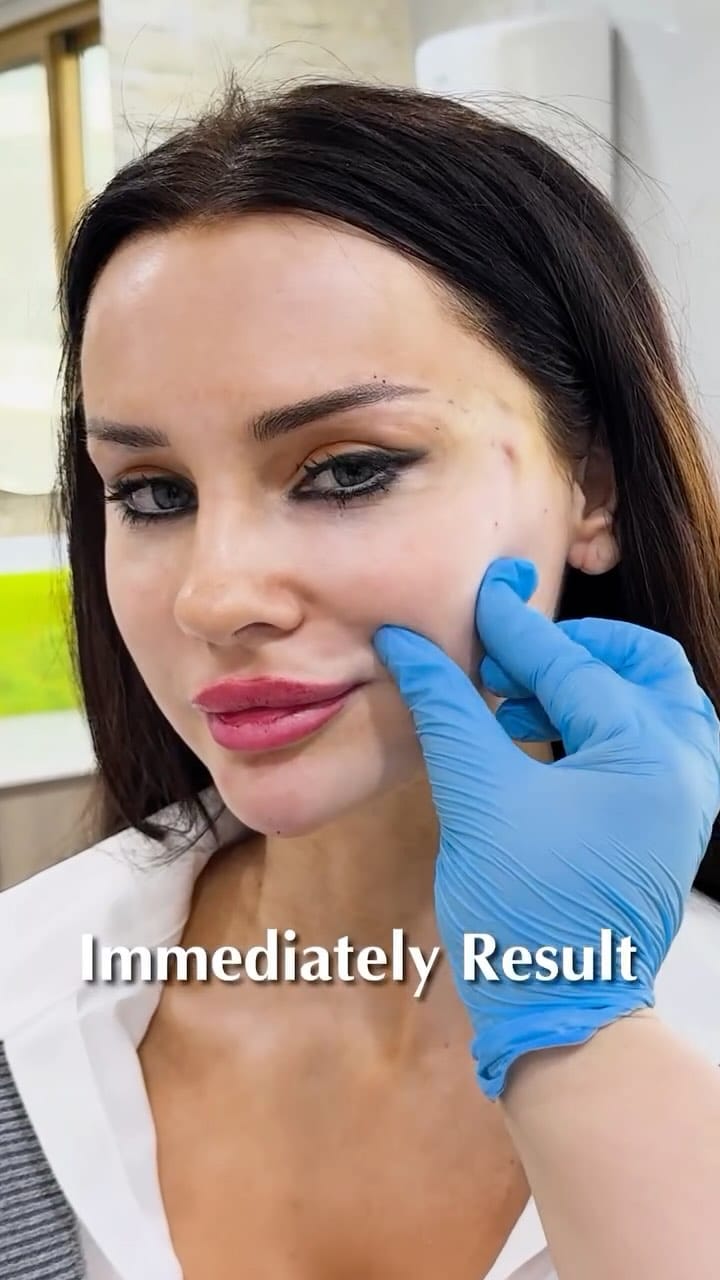 Post 9 by Dr Sima - BOTOX/LIP/FILLER/Endolift/Dubai on Instagram (video)