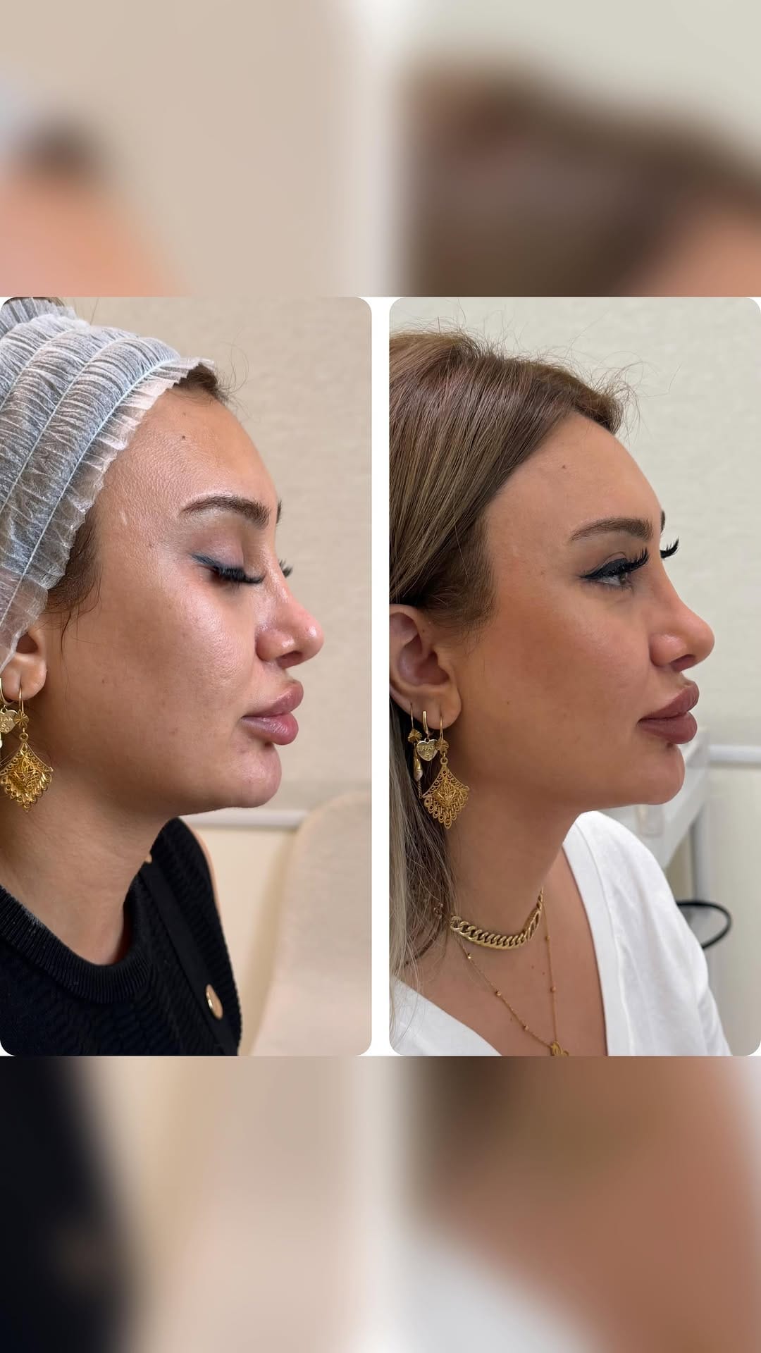 Post 7 by Dr Sima - BOTOX/LIP/FILLER/Endolift/Dubai on Instagram (video)