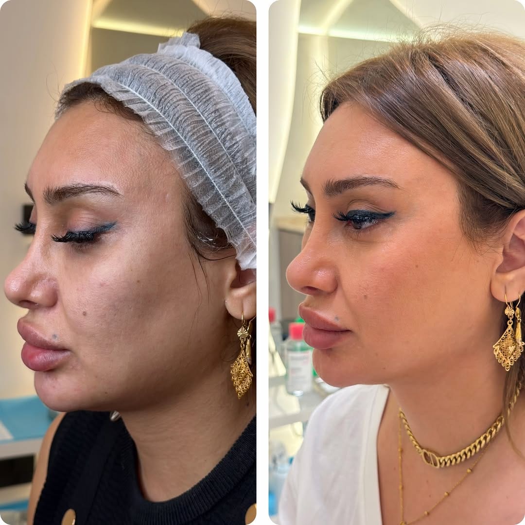 Post 6 by Dr Sima - BOTOX/LIP/FILLER/Endolift/Dubai on Instagram (carousel)