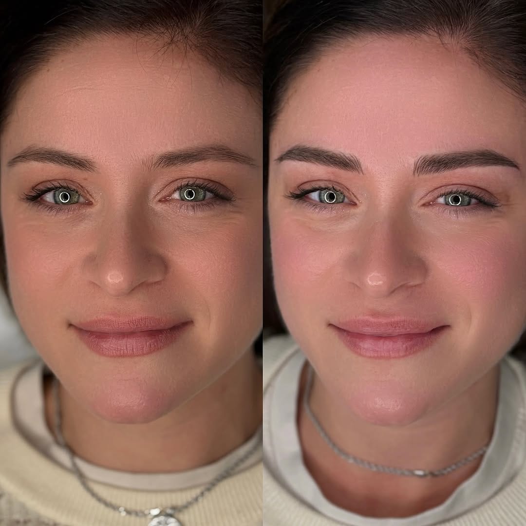 Post 5 by 𝐓𝐑𝐔𝐂𝐂𝐎 𝐏𝐄𝐑𝐌𝐀𝐍𝐄𝐍𝐓𝐄 - 𝐌𝐈𝐂𝐑𝐎𝐁𝐋𝐀𝐃𝐈𝐍𝐆 - 𝐏𝐈𝐄𝐑𝐂𝐈𝐍𝐆 📍𝐍𝐀𝐏𝐎𝐋𝐈 on Instagram (carousel)