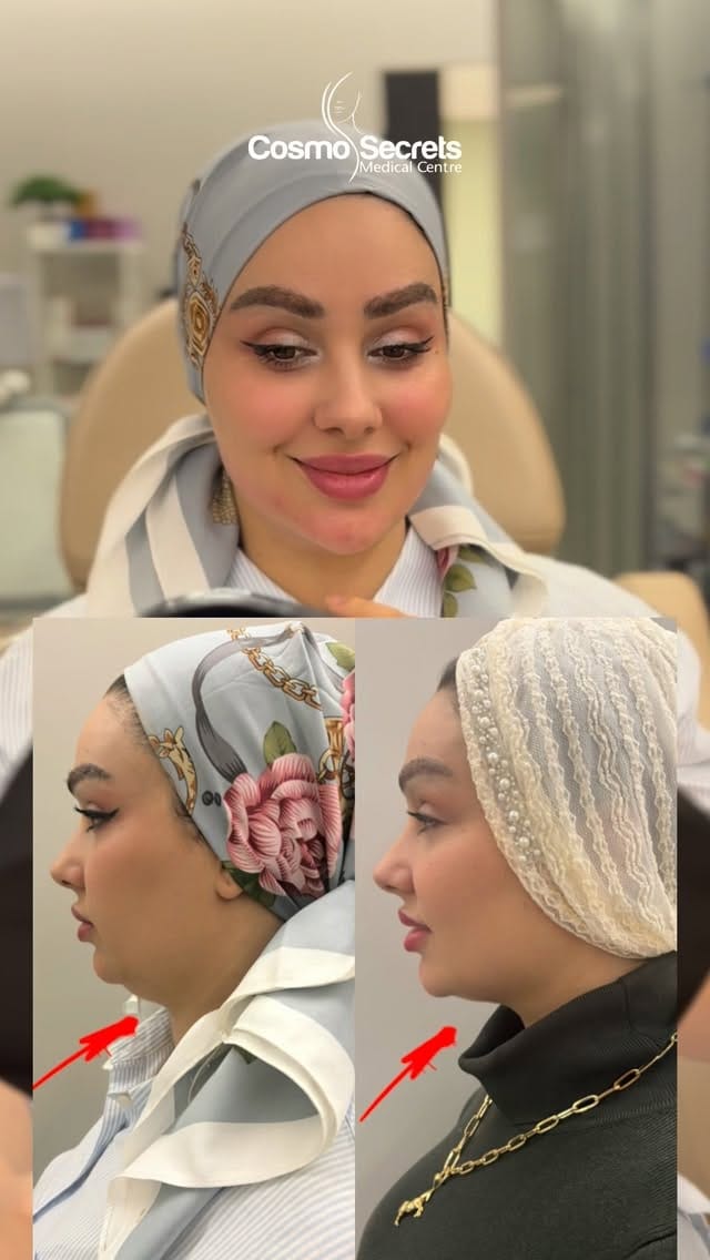 Post 4 by Cosmo Secret Medical Center on Instagram (video)
