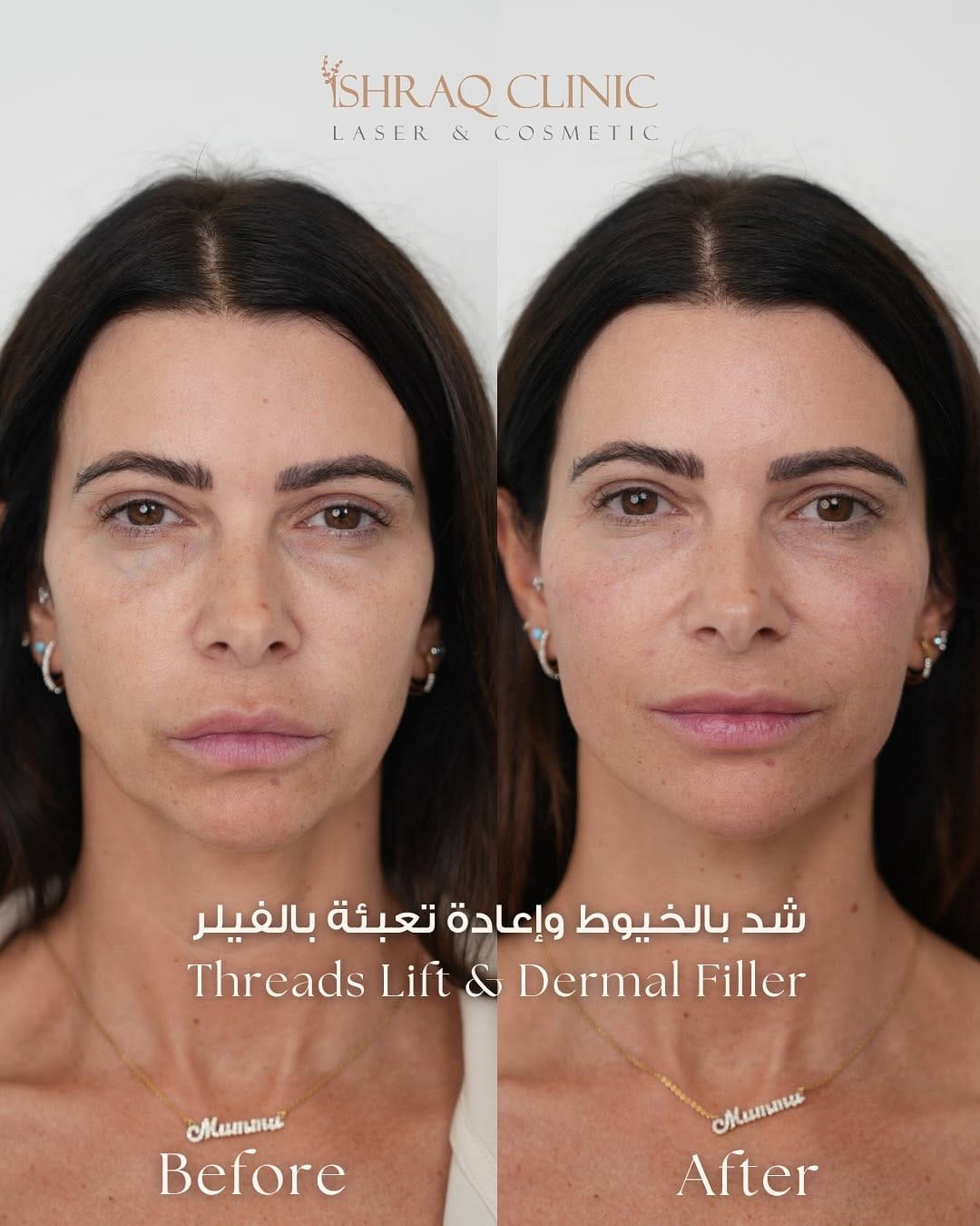 Post 5 by 𝗜𝗦𝗛𝗥𝗔𝗤 𝗖𝗟𝗜𝗡𝗜𝗖 | عيادة إشراق on Instagram (carousel)