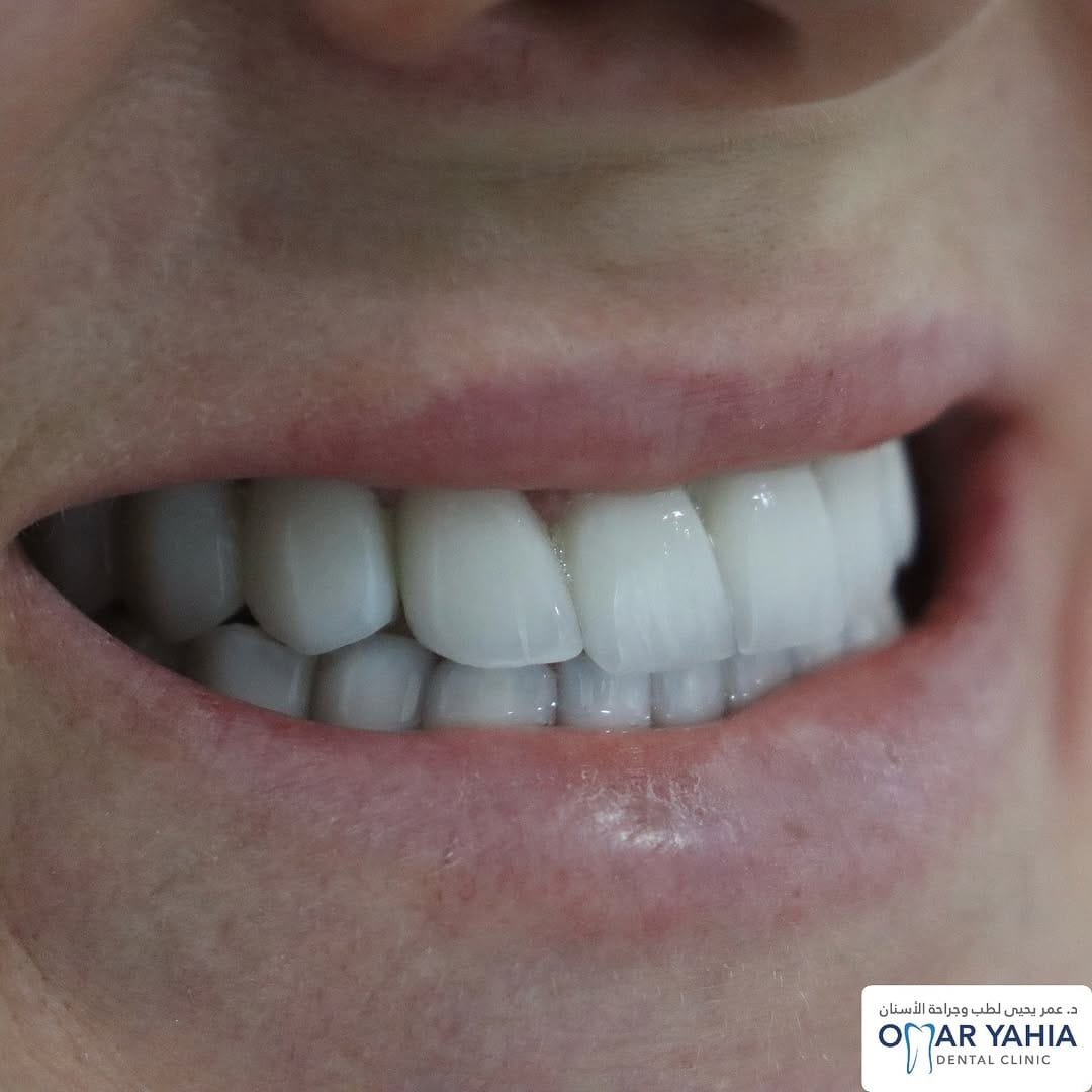 Post 4 by Omar Yahia Dental Clinic on Instagram (carousel)