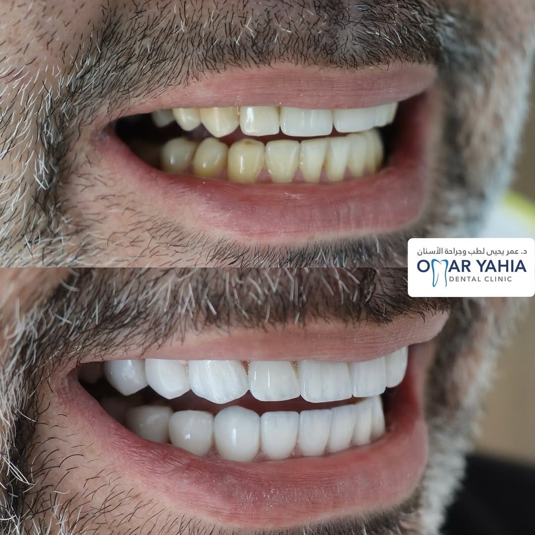 Post 1 by Omar Yahia Dental Clinic on Instagram (carousel)