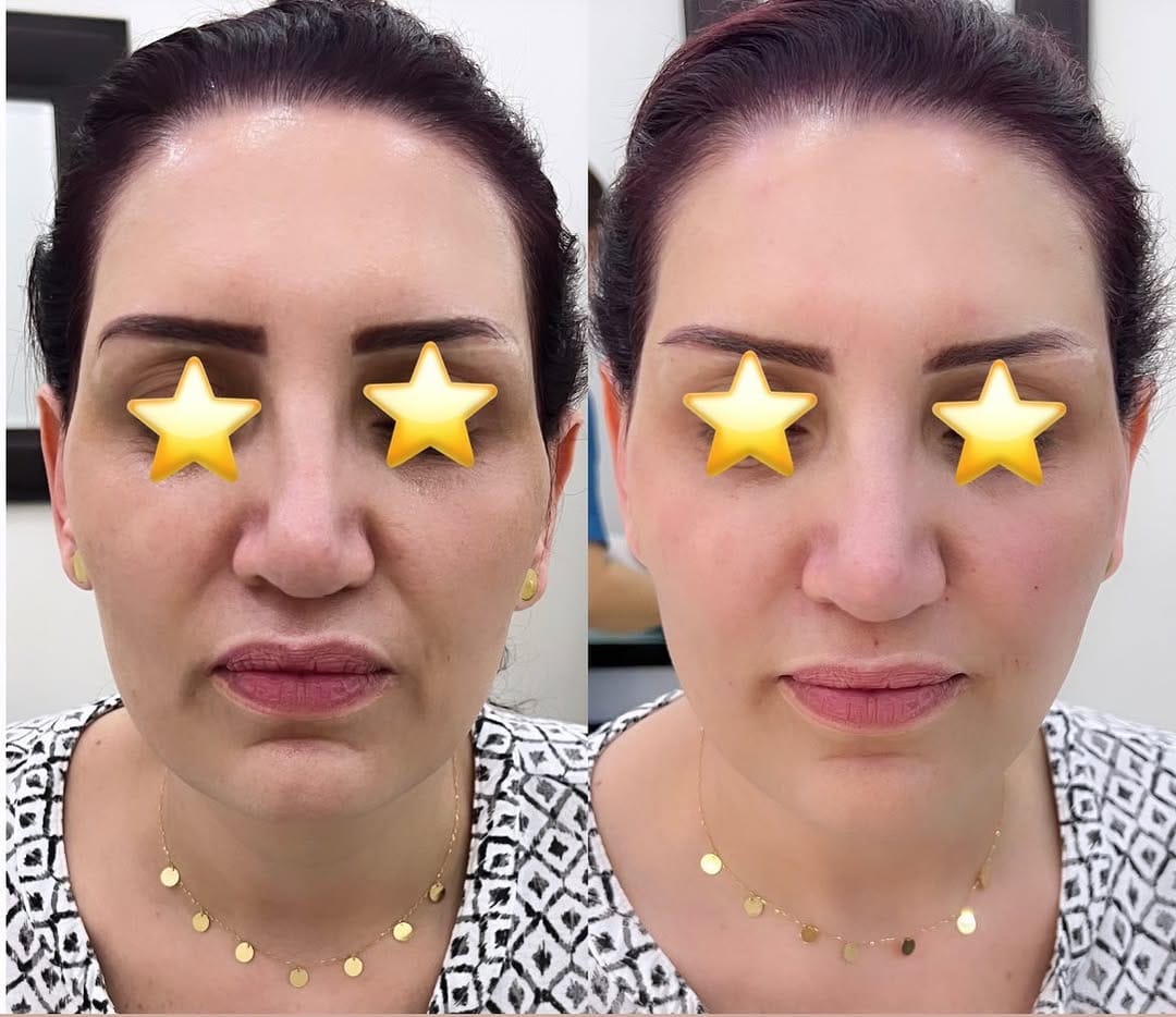 Post 10 by Dr Saman Zeeshan | Aesthetic Dermatology Dubai on Instagram (image)