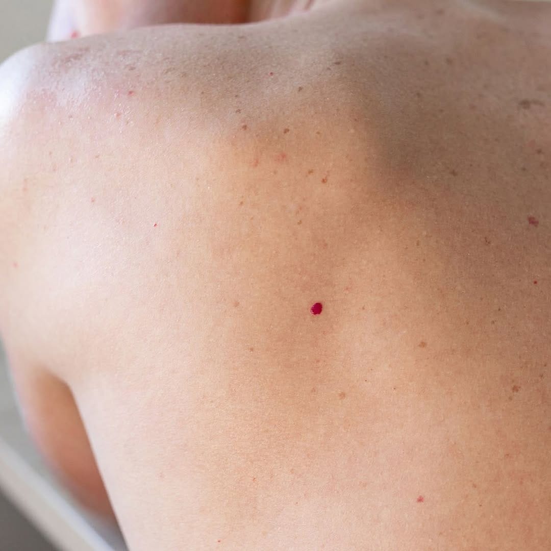 Post 5 by Dermatology | Skin Surgery on Instagram (carousel)