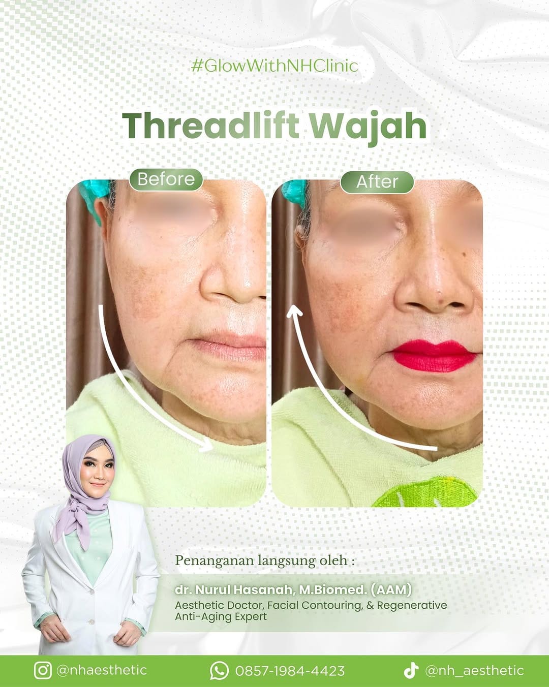 Post 4 by Klinik Kecantikan Tebet Jakarta Selatan | NHAesthetic on Instagram (image)