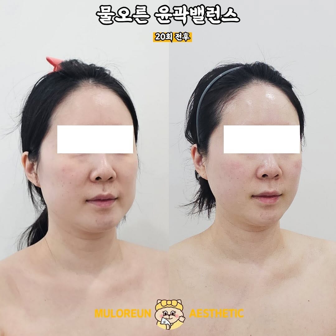 Post 9 by 대구웨딩케어 대구신부관리 대구피부관리 월성동에스테틱 대구윤곽관리 대구문제성피부 물오른피부 on Instagram (image)