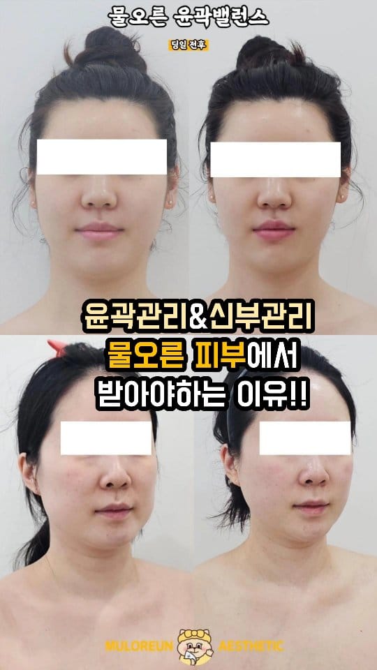 Post 8 by 대구웨딩케어 대구신부관리 대구피부관리 월성동에스테틱 대구윤곽관리 대구문제성피부 물오른피부 on Instagram (video)