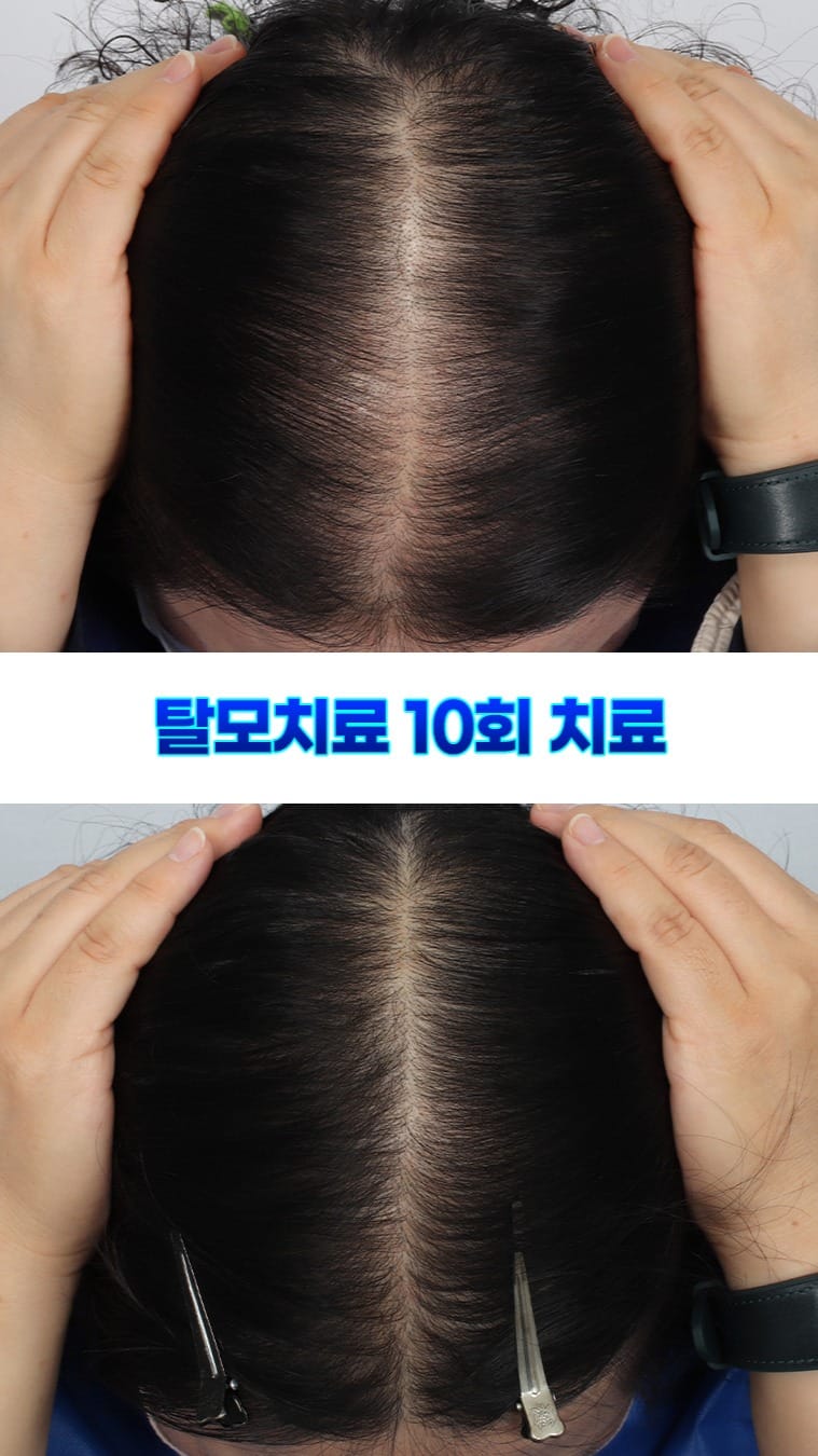 Post 4 by 맥스웰피부과 on Instagram (video)