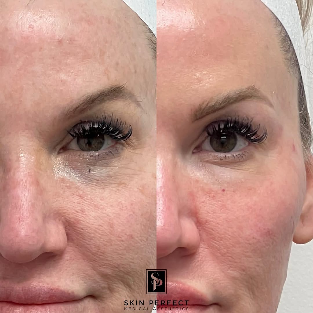Post 8 by Skin Perfect Rancho Cucamonga on Instagram (carousel)