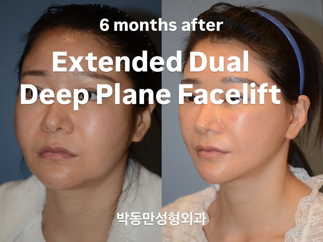 Post 10 by PDM Plastic Surgery Clinic on Instagram (image)