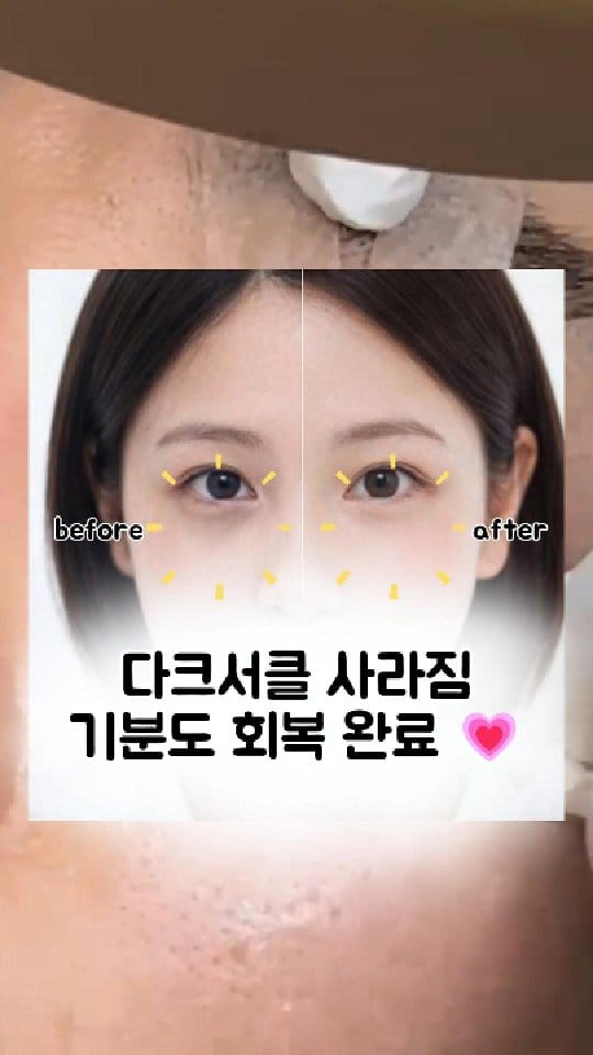 Post 4 by 눈밑지방재배치 눈밑 눈밑꺼짐  다크서클반영구 다크서클커버 대구타투  헤나 기미타투  기미제거 기미크림 다크서클 on Instagram (video)