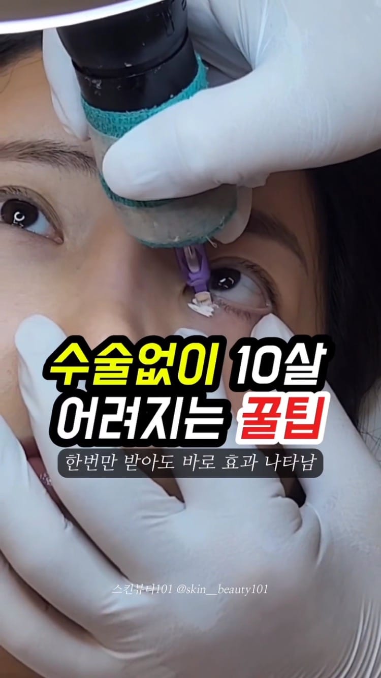 Post 9 by 눈밑지방재배치 눈밑 눈밑꺼짐  다크서클반영구 다크서클커버 대구타투  헤나 기미타투  기미제거 기미크림 다크서클 on Instagram (video)