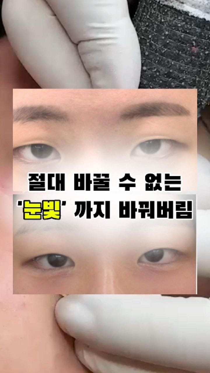 Post 2 by 눈밑지방재배치 눈밑 눈밑꺼짐  다크서클반영구 다크서클커버 대구타투  헤나 기미타투  기미제거 기미크림 다크서클 on Instagram (video)