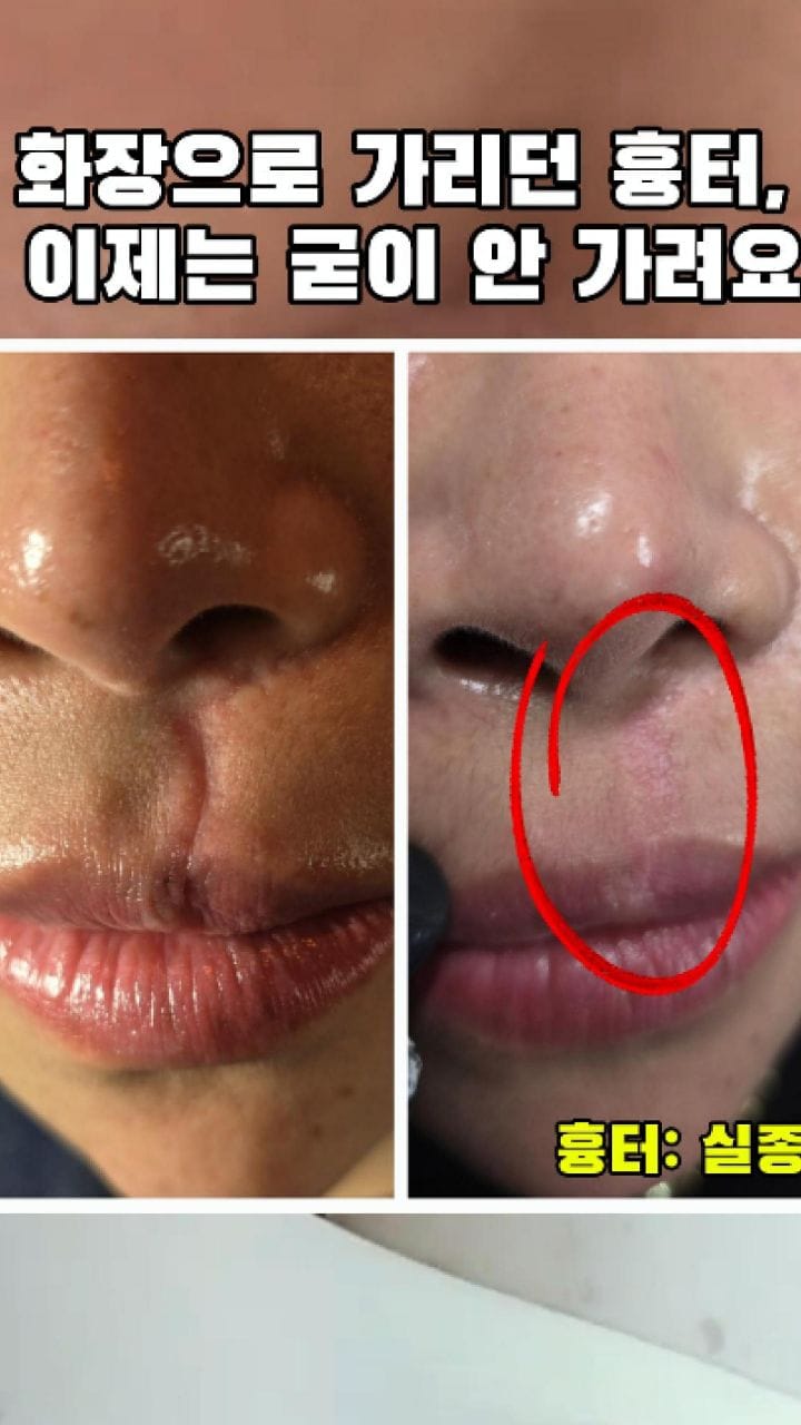 Post 6 by 눈밑지방재배치 눈밑 눈밑꺼짐  다크서클반영구 다크서클커버 대구타투  헤나 기미타투  기미제거 기미크림 다크서클 on Instagram (video)