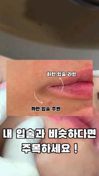 Post 7 by 눈밑지방재배치 눈밑 눈밑꺼짐  다크서클반영구 다크서클커버 대구타투  헤나 기미타투  기미제거 기미크림 다크서클 on Instagram (video)