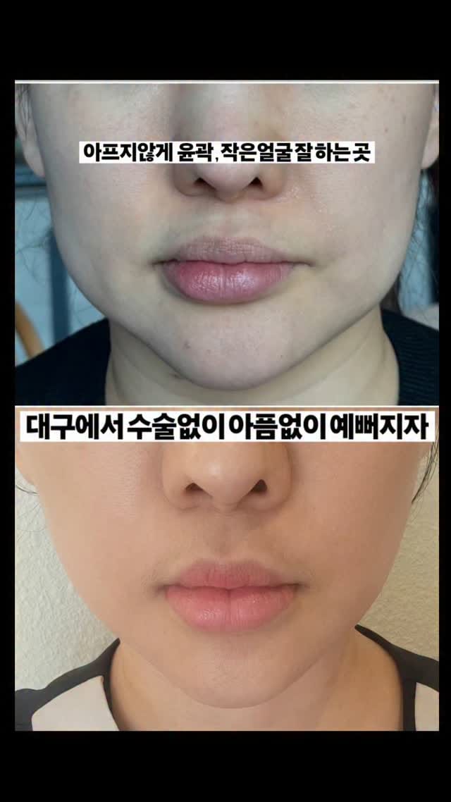 Post 10 by 관리의 전 후 차이를 보여주는 전문적인  건강미대구점 ㅣ산전산후 ㅣ웨딩관리 ㅣ 작은얼굴 ㅣ림프마사지 on Instagram (video)