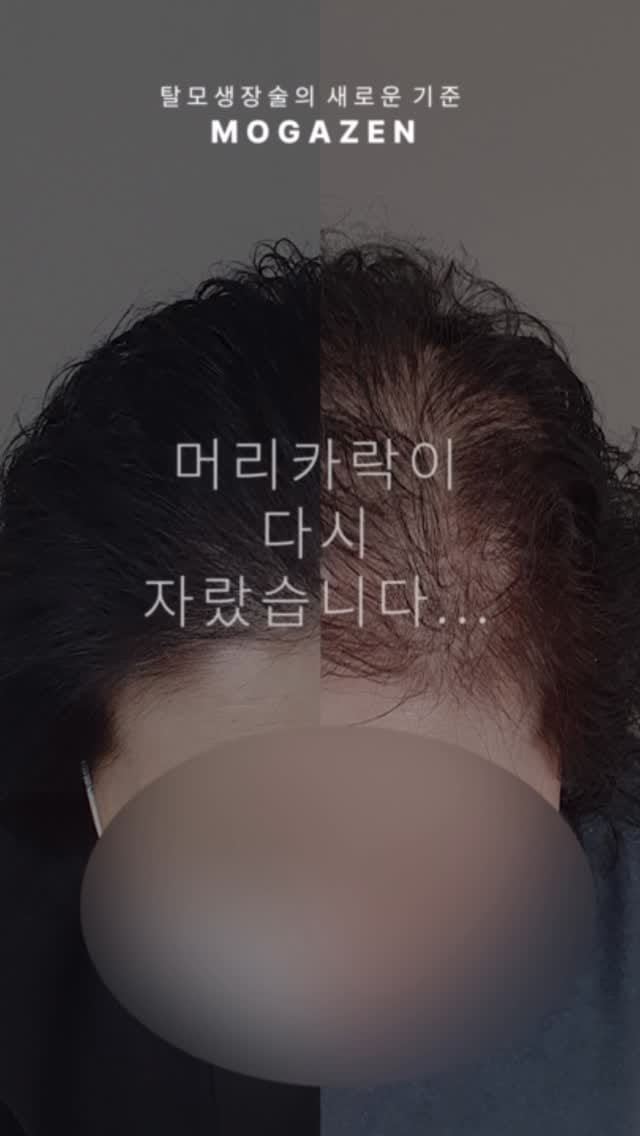 Post 6 by 안산두피문신SMP | 강남두피문신 | 리아트스칼프 |헤어라인 유륜 입술 대표원장 RIA_리아 on Instagram (video)