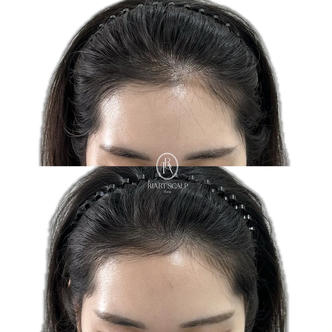 Post 10 by 안산두피문신SMP | 강남두피문신 | 리아트스칼프 |헤어라인 유륜 입술 대표원장 RIA_리아 on Instagram (image)