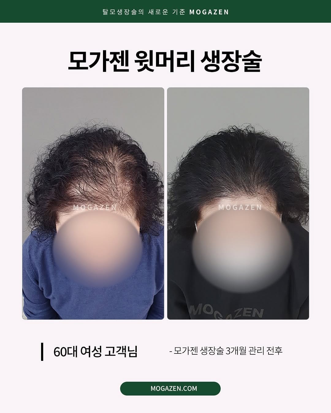 Post 5 by 안산두피문신SMP | 강남두피문신 | 리아트스칼프 |헤어라인 유륜 입술 대표원장 RIA_리아 on Instagram (carousel)