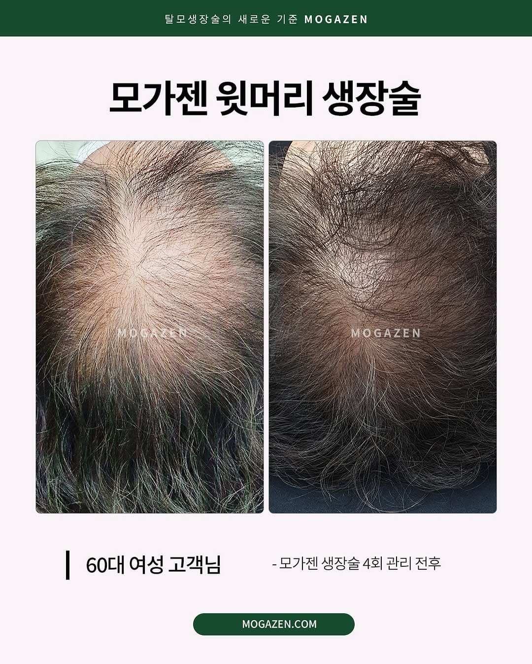 Post 7 by 안산두피문신SMP | 강남두피문신 | 리아트스칼프 |헤어라인 유륜 입술 대표원장 RIA_리아 on Instagram (image)