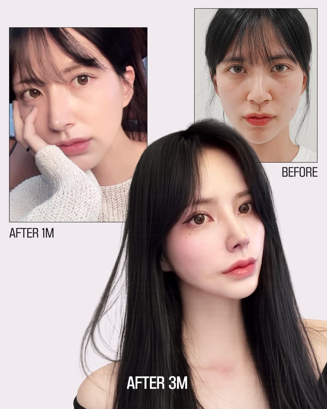 Post 3 by 브라운성형외과 on Instagram (image)