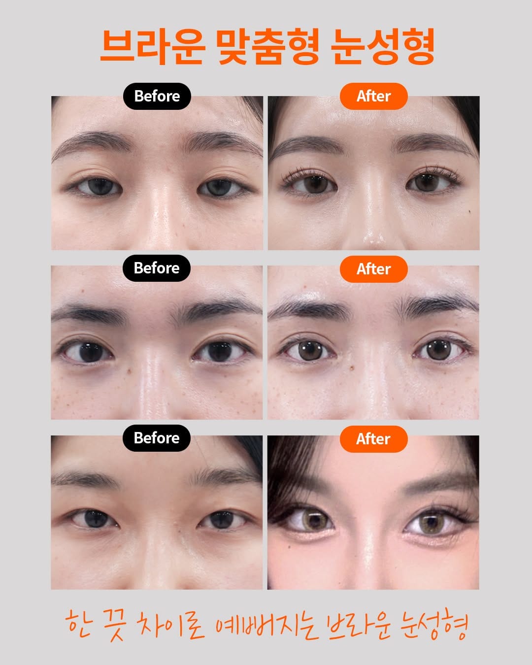 Post 8 by 브라운성형외과 on Instagram (image)