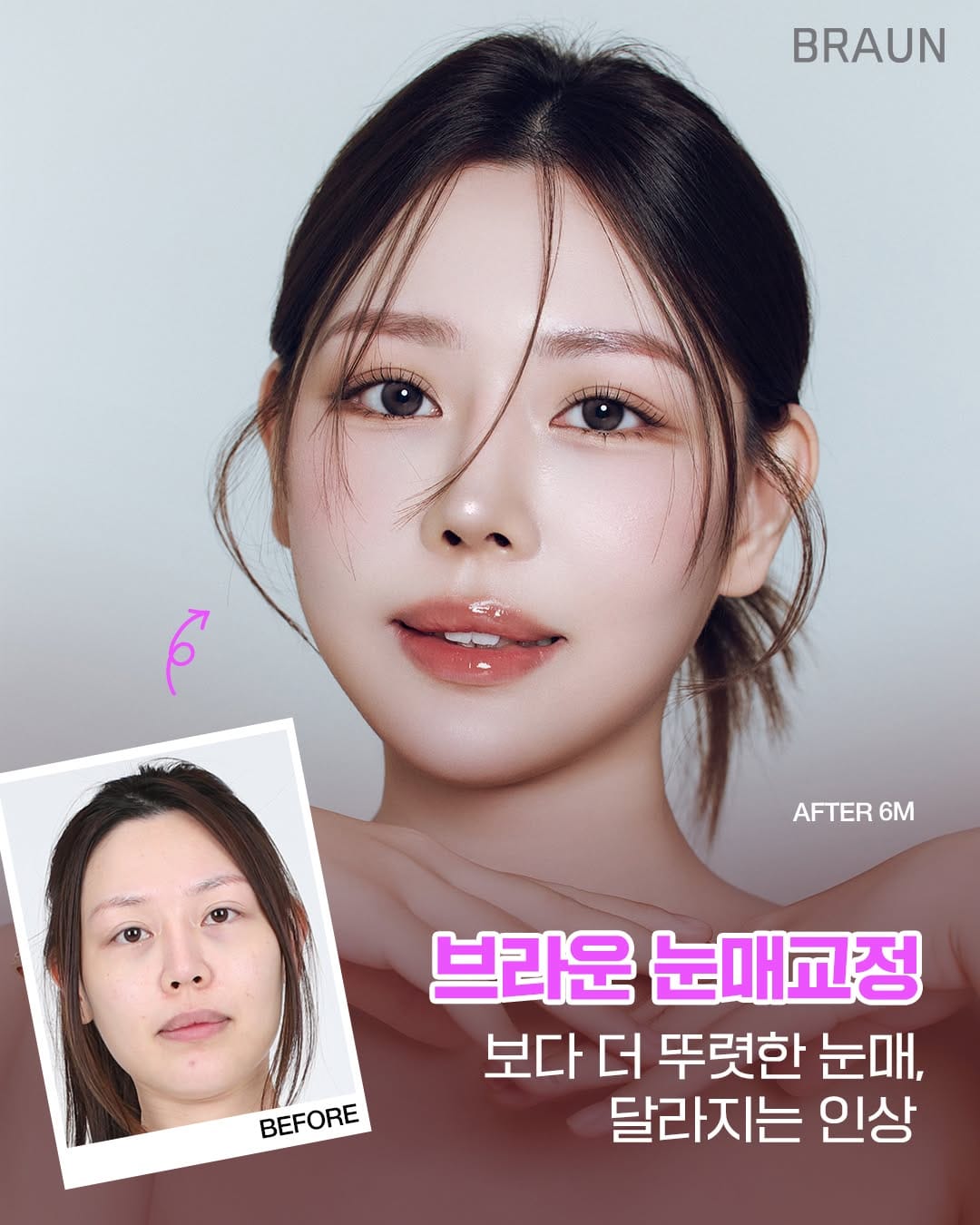 Post 6 by 브라운성형외과 on Instagram (image)