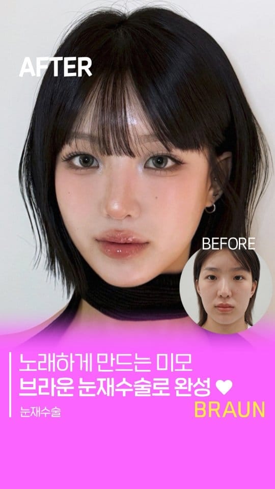 Post 10 by 브라운성형외과 on Instagram (video)