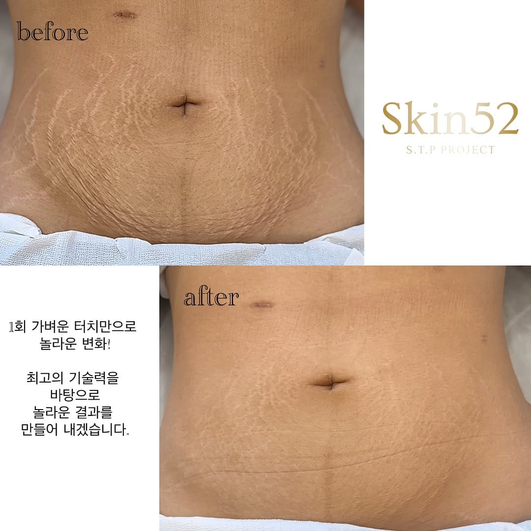 Post 2 by 튼살커버 /대구눈썹문신잘하는곳/스킨52 on Instagram (image)