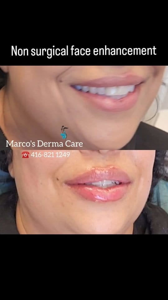 Post 10 by Marco's Derma Care on Instagram (video)