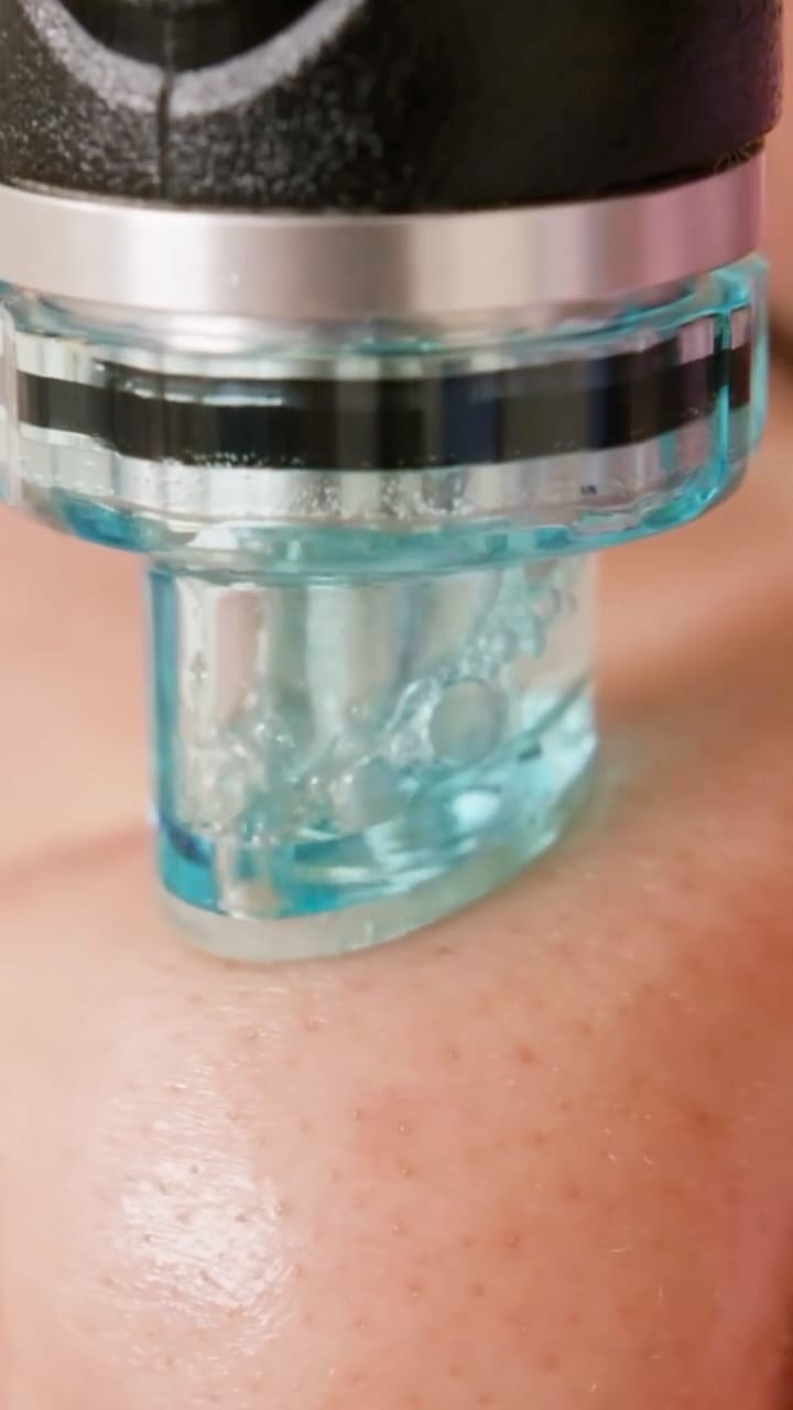 Post 3 by Laser & Skin Clinic Manchester on Instagram (video)