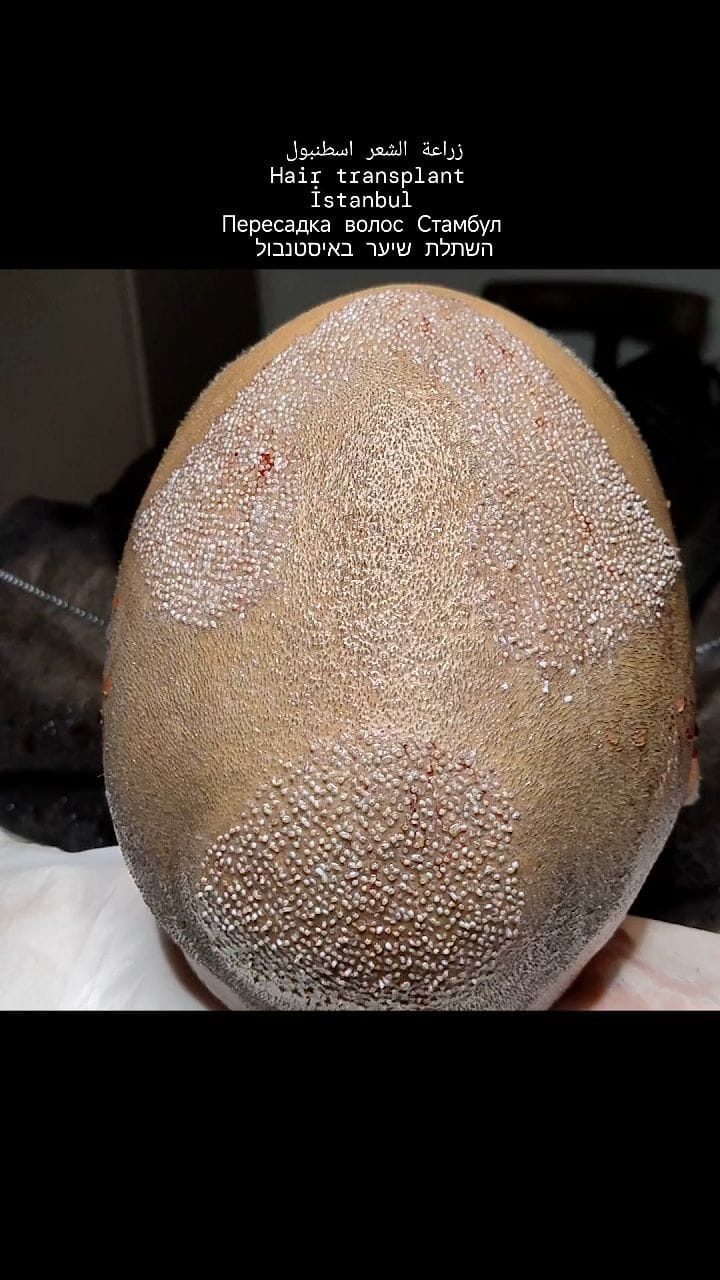 Post 2 by Hair Transplant istanbul&Plastic Surgeries& FUE - DHI on Instagram (video)
