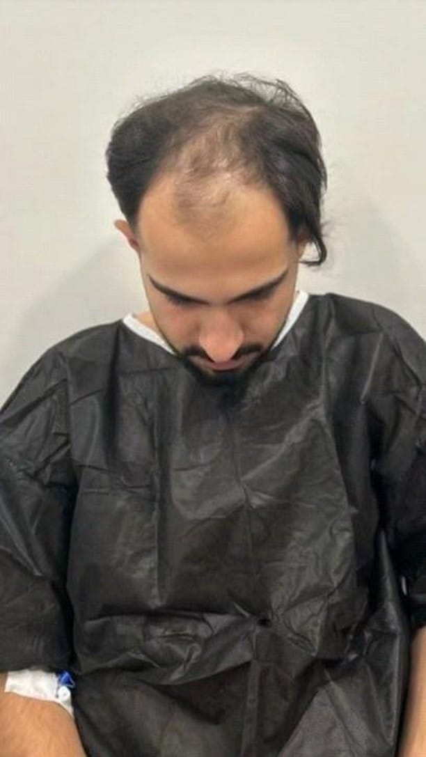 Post 9 by Hair Transplant istanbul&Plastic Surgeries& FUE - DHI on Instagram (video)