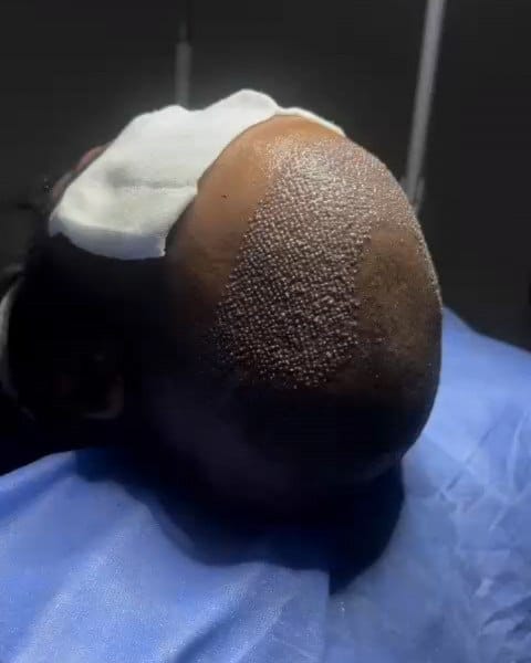 Post 1 by Hair Transplant istanbul&Plastic Surgeries& FUE - DHI on Instagram (carousel)