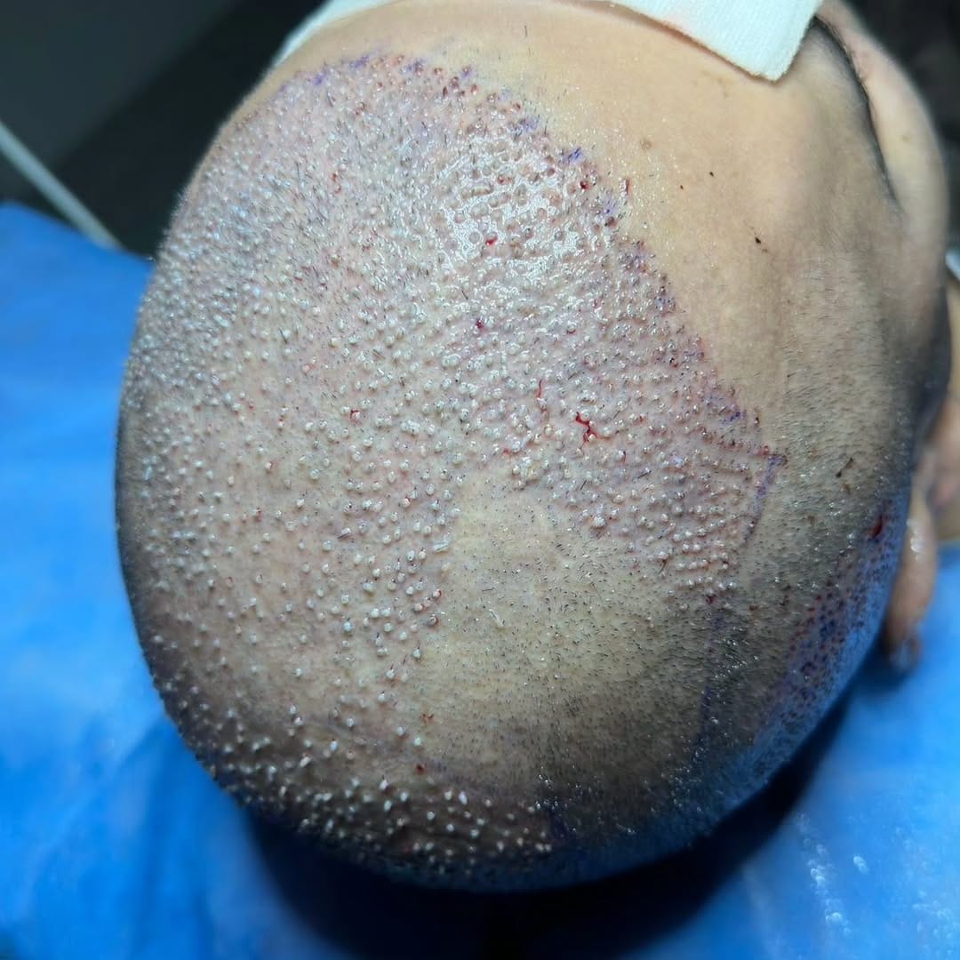 Post 6 by Hair Transplant istanbul&Plastic Surgeries& FUE - DHI on Instagram (carousel)