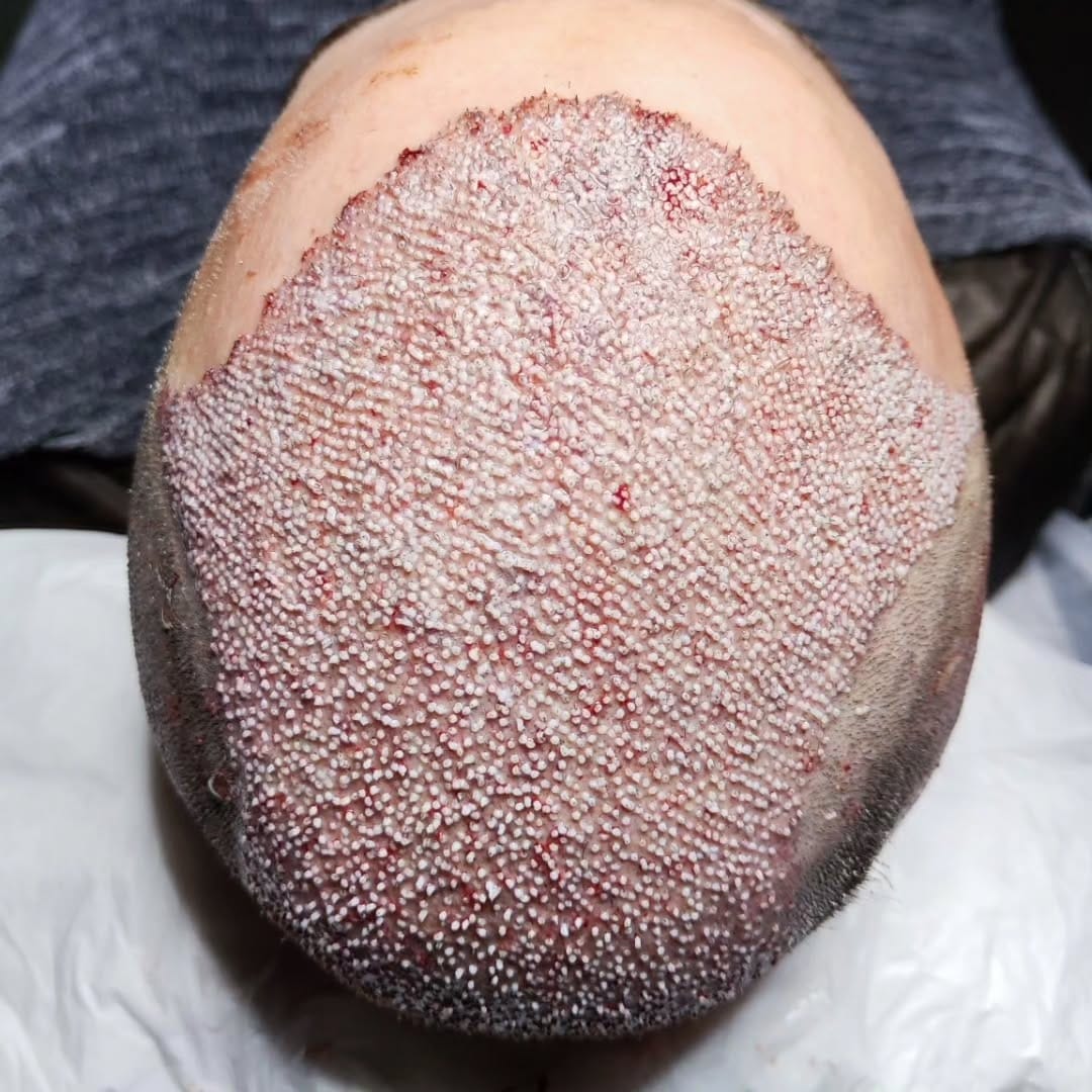 Post 8 by Hair Transplant istanbul&Plastic Surgeries& FUE - DHI on Instagram (carousel)