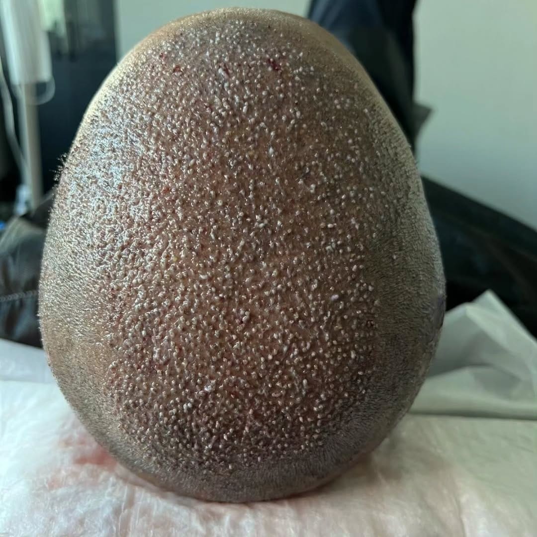 Post 7 by Hair Transplant istanbul&Plastic Surgeries& FUE - DHI on Instagram (carousel)