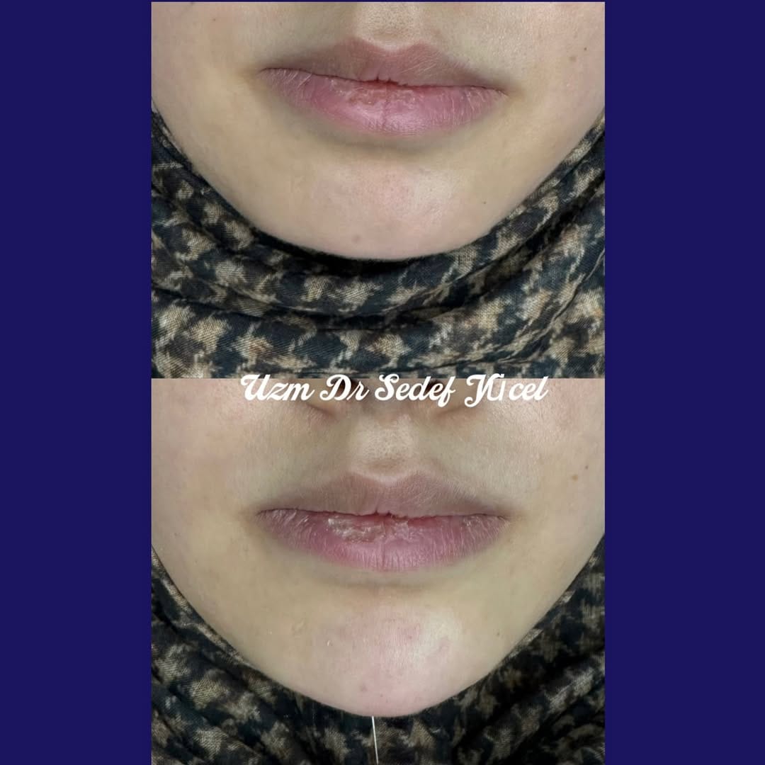 Post 1 by Uz.Dr. Sedef Yücel-Dermatolog on Instagram (carousel)