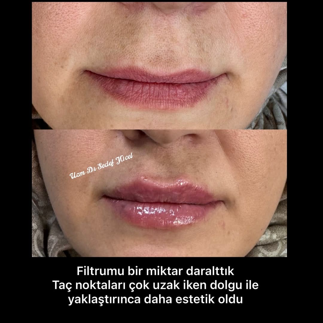 Post 4 by Uz.Dr. Sedef Yücel-Dermatolog on Instagram (image)