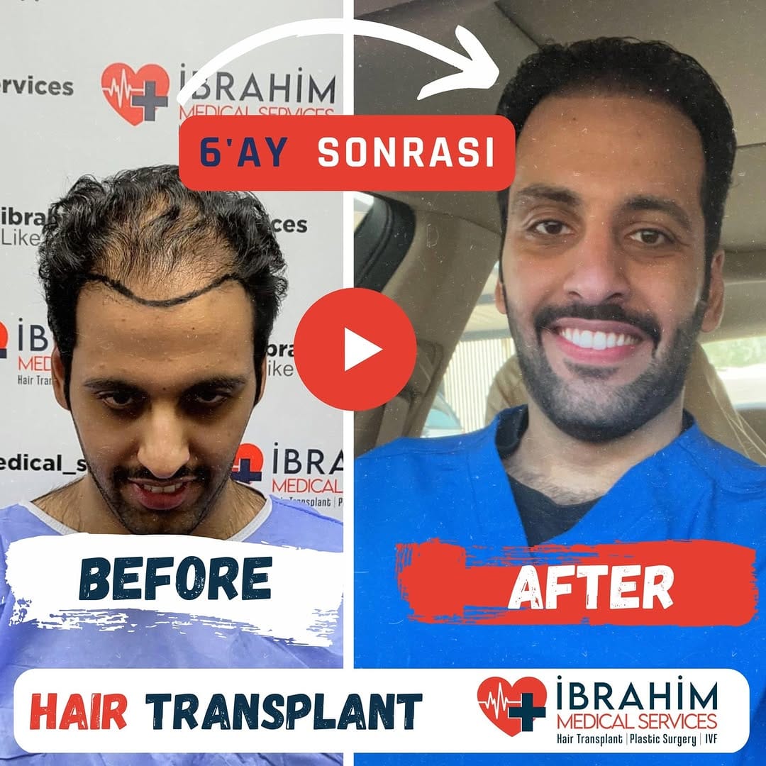Post 1 by İbrahim Ayyıldız on Instagram (video)