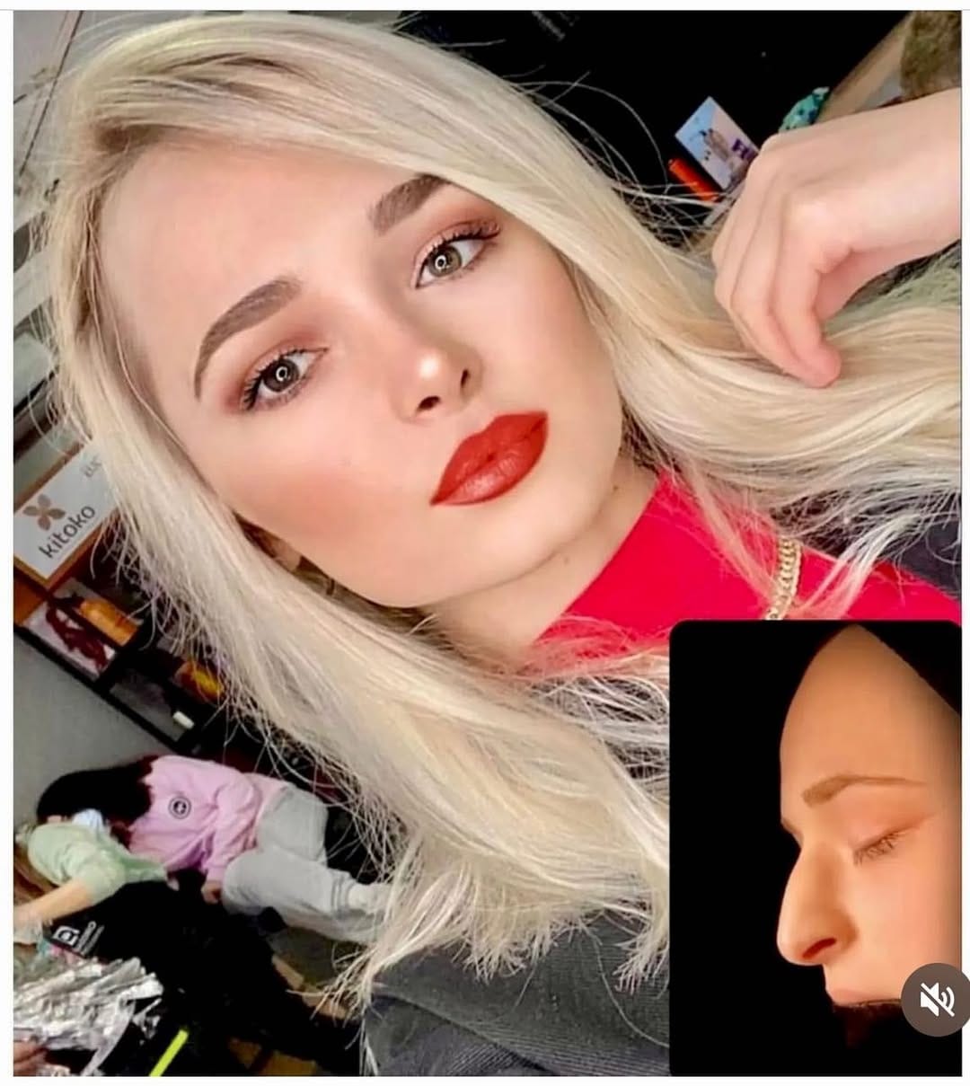 Post 8 by Dr. Hakan KARA- Rhinoplasty on Instagram (image)