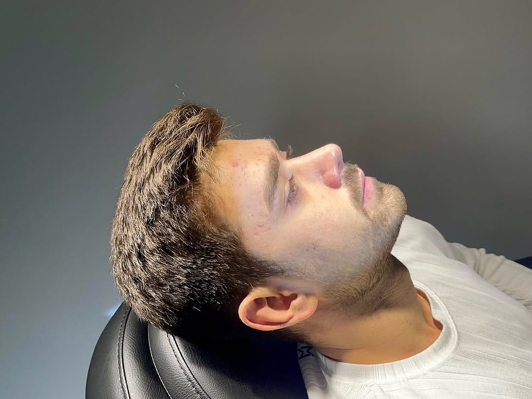 Post 5 by Dr. Hakan KARA- Rhinoplasty on Instagram (carousel)
