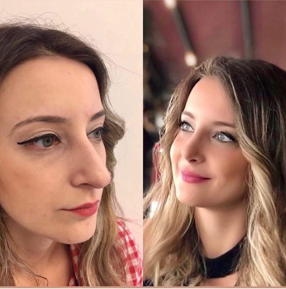 Post 9 by Dr. Hakan KARA- Rhinoplasty on Instagram (image)
