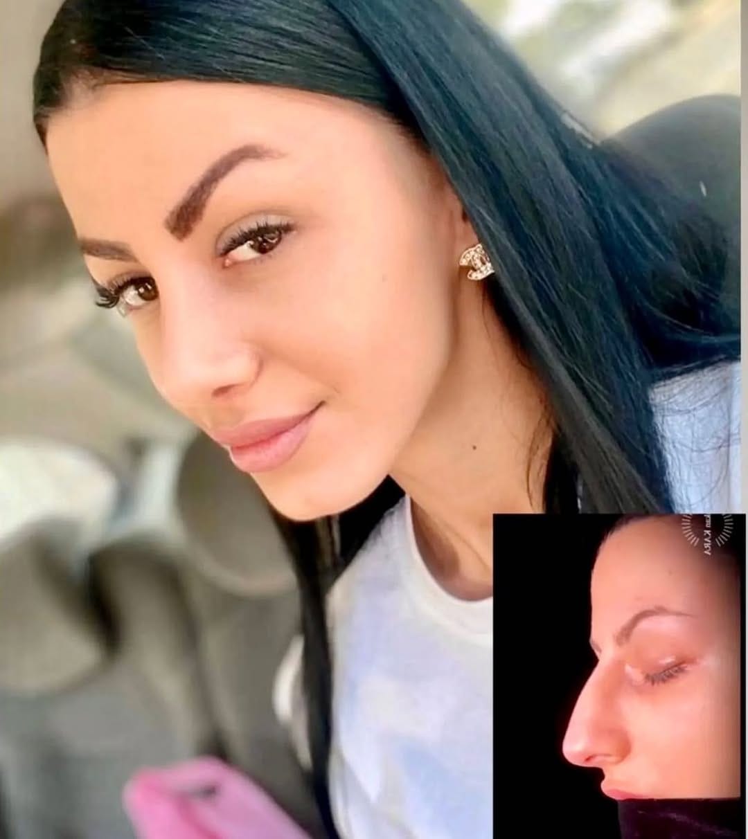 Post 10 by Dr. Hakan KARA- Rhinoplasty on Instagram (carousel)
